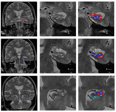 Association of Tau Pathology With Clinical Symptoms in the Subfields of Hippocampal Formation